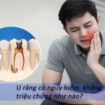U răng là gì? Có nguy hiểm không? Điều trị ra sao?