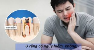 U răng là gì? Có nguy hiểm không?