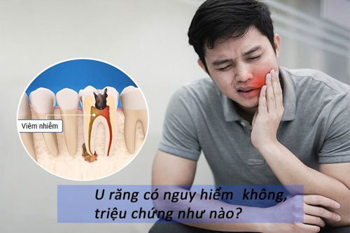 Read more about the article U răng là gì? Có nguy hiểm không? Điều trị ra sao?