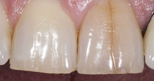 Vết nứt tương đối rõ rệt và có thể đã đi vào ngà răng