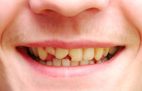 Răng bị mẻ vỡ ảnh hưởng nhiều đến thẩm mỹ
