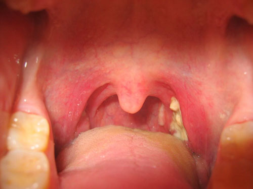 Viêm họng do liên cầu khuẩn là nguyên nhân gây khô họng