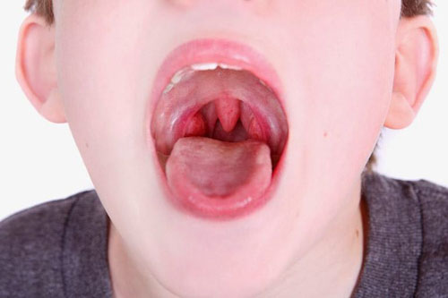 Viêm họng liên cầu khuẩn là nguyên nhân gây đau họng khi nuốt nước bọt