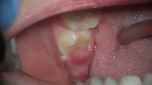 Viêm lợi trùm là nguyên nhân gây ra những cơn đau nhức khi mọc răng khôn