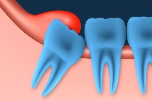 Viêm lợi trùm là tình trạng phần mô nướu trên răng khôn bị sưng viêm