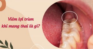 Read more about the article Viêm lợi trùm răng khôn khi mang thai cần làm gì?
