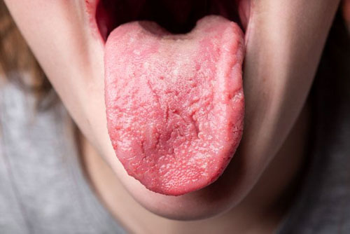 Viêm lưỡi là tình trạng sưng đau trên bề mặt lưỡi