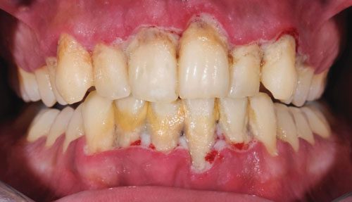 Viêm nha chu là một trong những nguyên nhân phổ biến khiến răng lung lay