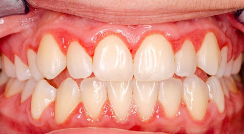 Viêm nướu dễ gây nên tình trạng răng nhạy cảm