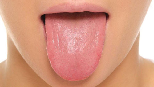Viêm teo lưỡi khiến bề mặt lưỡi khá bóng