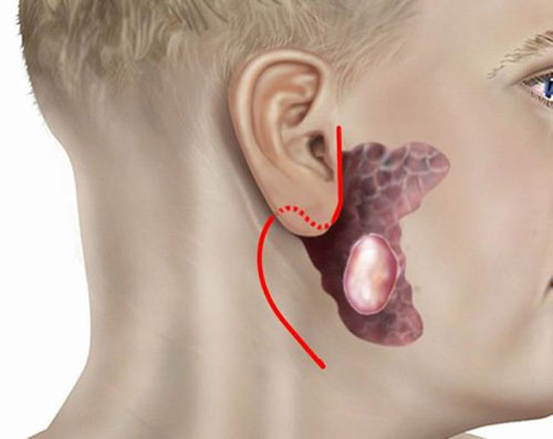 Viêm tuyến nước bọt mang tai hình thành những khối u ác tính