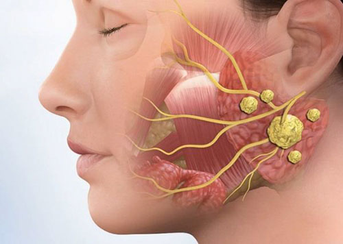 Viêm tuyến nước bọt mang tai xảy ra do tình trạng nhiễm khuẩn tuyến nước bọt