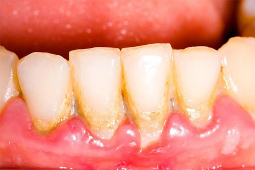 Vôi răng là một trong những nguyên nhân phổ biến gây mài mòn men răng