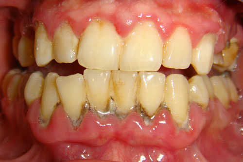Vôi răng là nguyên nhân chính gây ra các bệnh lý răng miệng nguy hiểm
