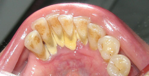 Vôi răng là những mảng bám cứng có màu vàng hoặc nâu